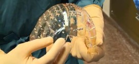 Un hospital holandés implanta el primer cráneo plástico impreso en 3D
