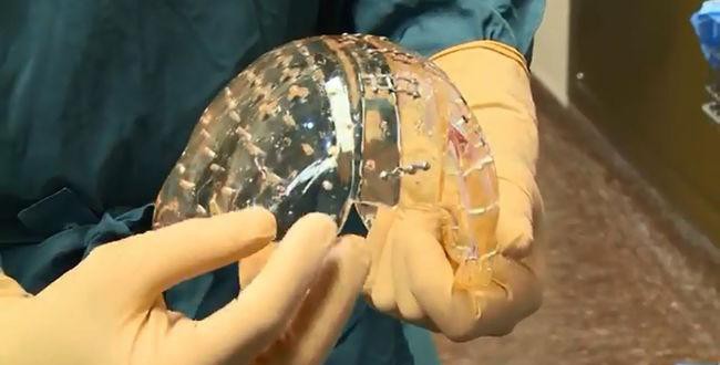 Un hospital holandés implanta el primer cráneo plástico impreso en 3D